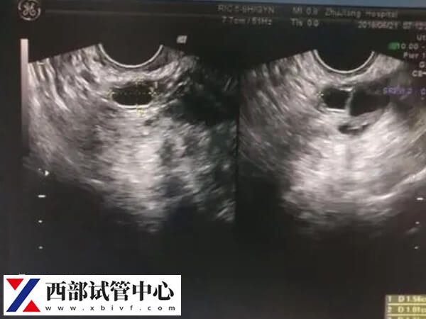 監(jiān)測排卵可以找到排卵期